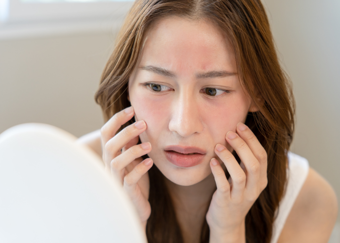 cách chữa da mặt bị cháy nắng