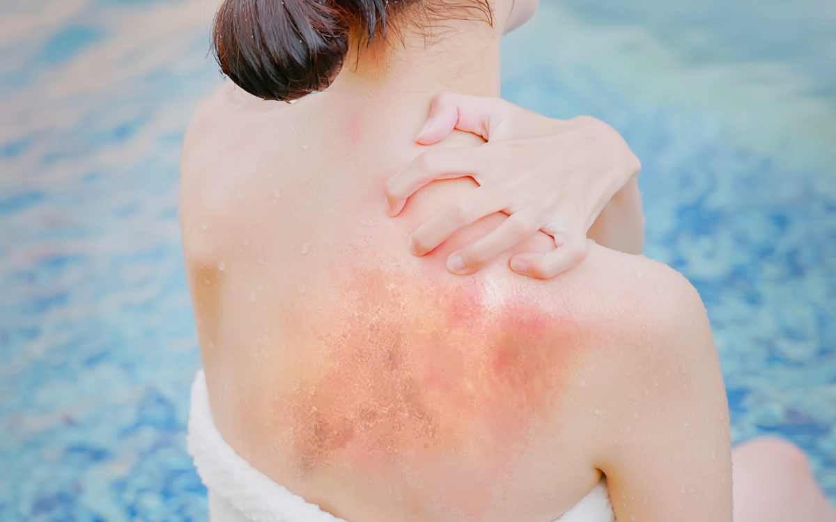 mặt nạ nha đam cho da cháy nắng