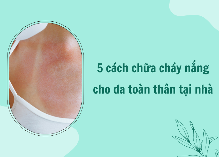 cách chữa cháy nắng cho da toàn thân