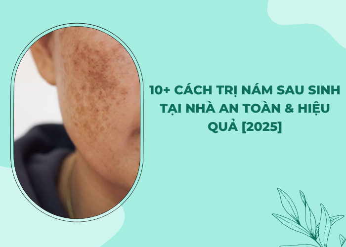 cách trị nám sau sinh tại nhà