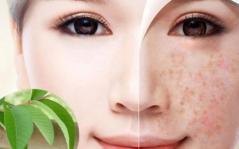 trị nám bằng lá ổi